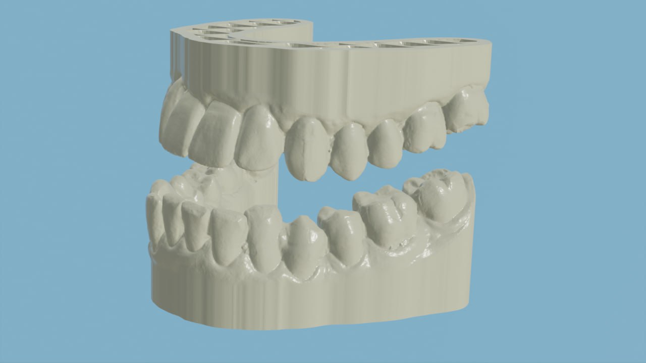 Customized Anti-Snoring Solution Bite