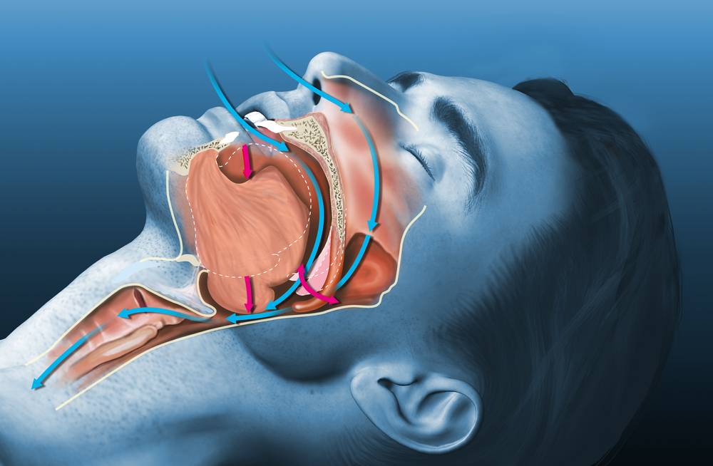 Why do we snore?